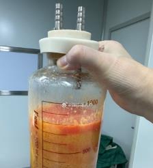 宜春水动力吸脂手术要做多久？